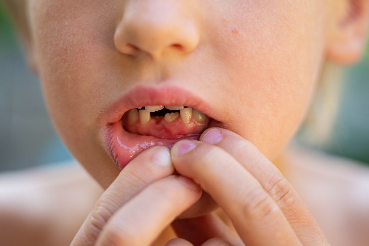 What Causes Baby Bottle Tooth Decay and How to Prevent It